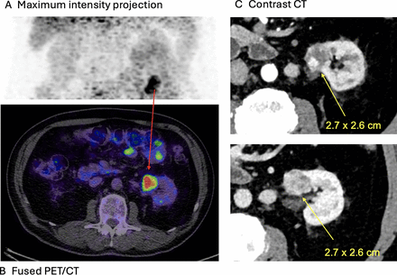 Novel radiopharmaceuticals for molecular imaging of renal cell ...